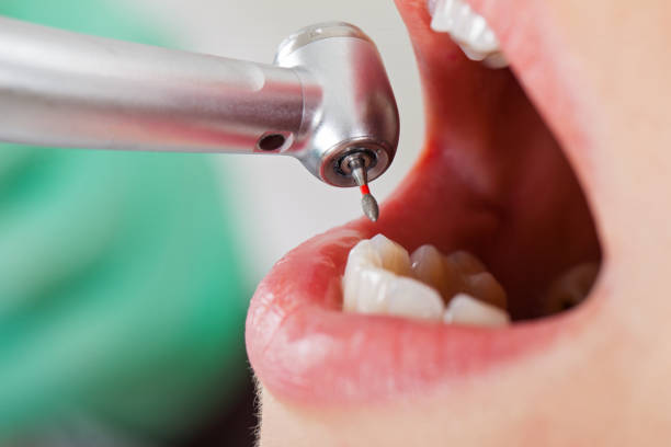 Best Emergency Wisdom Teeth Removal in Three Oaks, FL